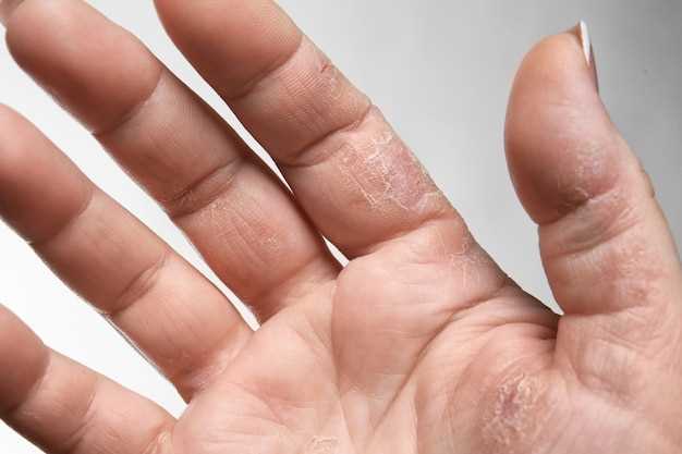 Медицинские препараты для удаления бородавок на пальце